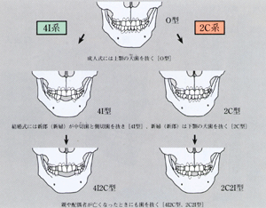 西日本の晩期縄紋人の抜歯